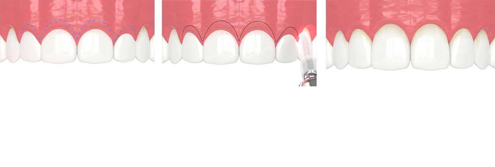 3D rendering of the step-by-step procedure of laser treatment for gummy smile in the upper jaw and creation of a new gum line