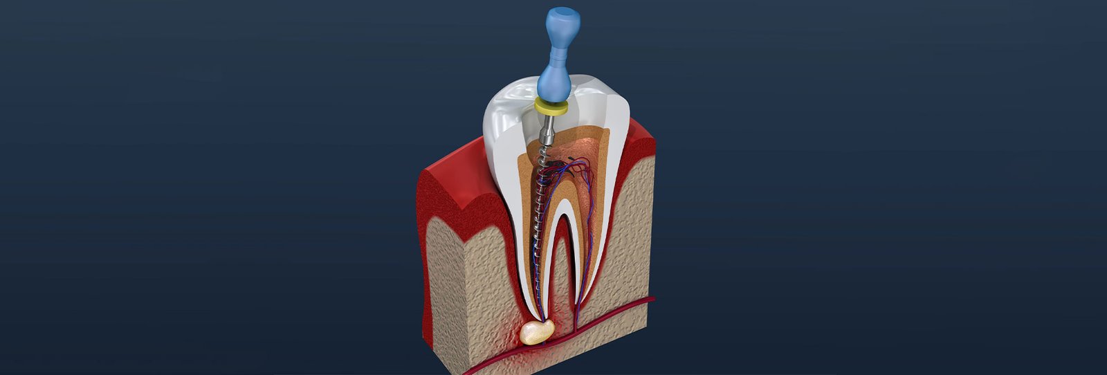 Root canal treatment process. 3D illustration